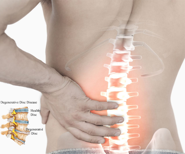 DEGENERATIVE DISC DISEASE clinic