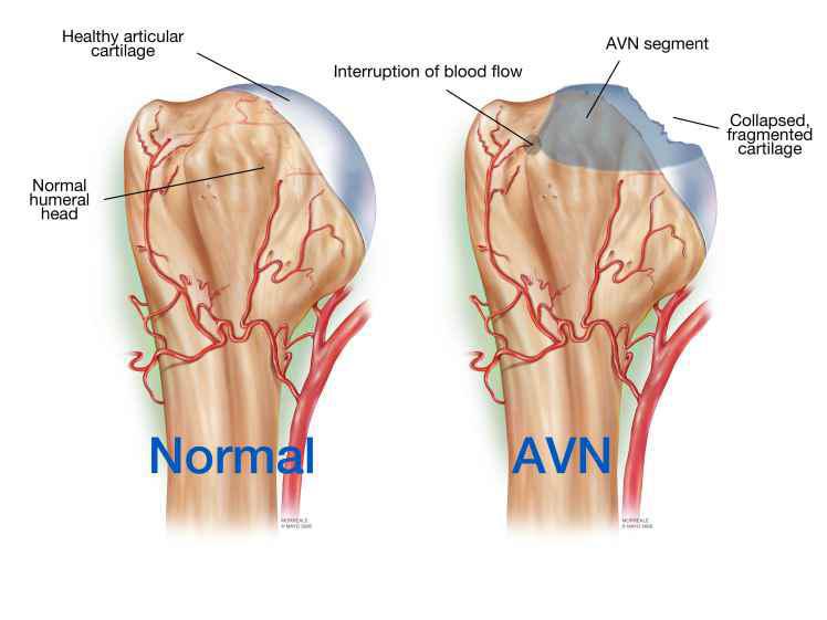 Avascular-Necrosis-of-Hip-pain-treatment