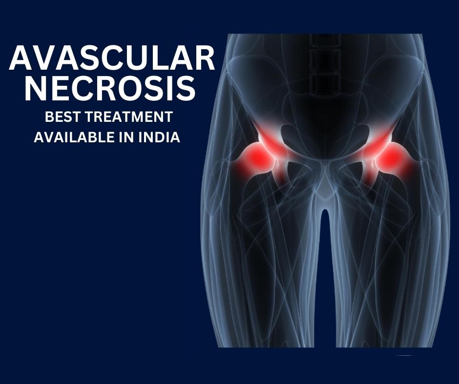 Physiotherapy treatment in Noida of Avascular Necrosis of Hip