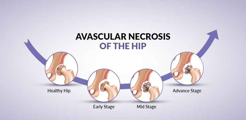 Avascular necrosis (AVN) Physiotherapy Treatment
