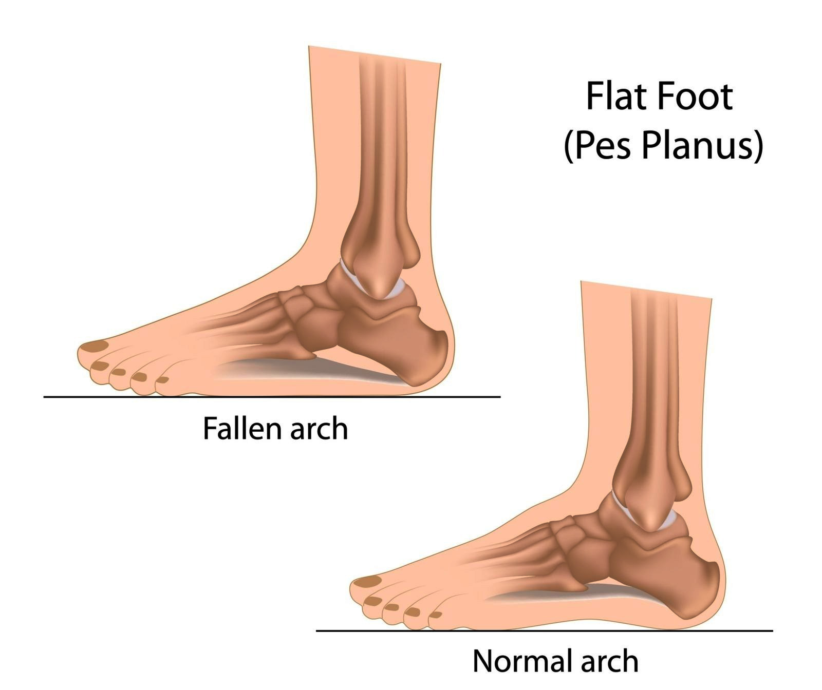 flat feet physiotherapist noida