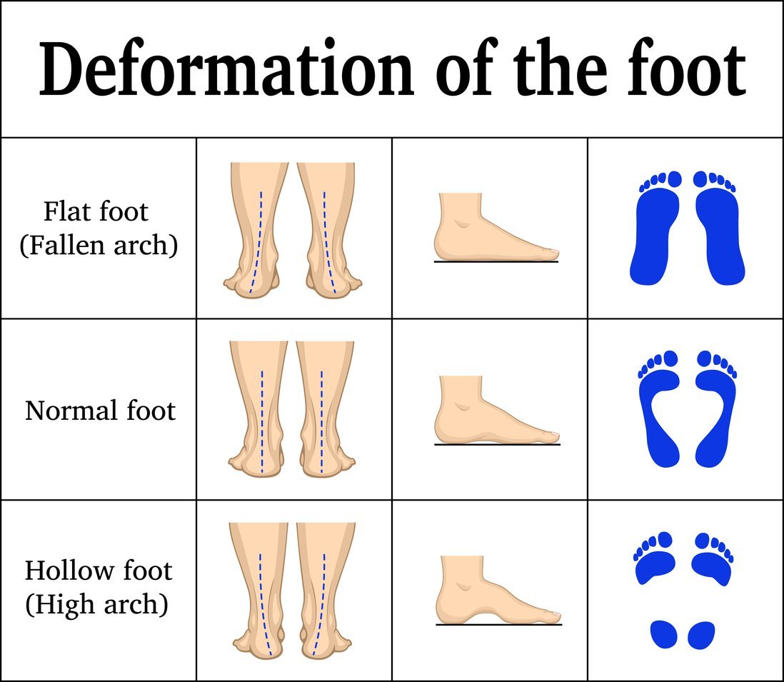 flat feet physiotherapy treatment in delhi