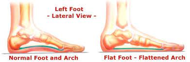 Flat Feet Treatment in Noida