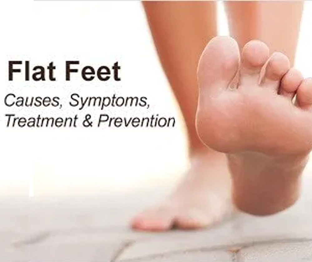 physiotherapy doctor for flat feet