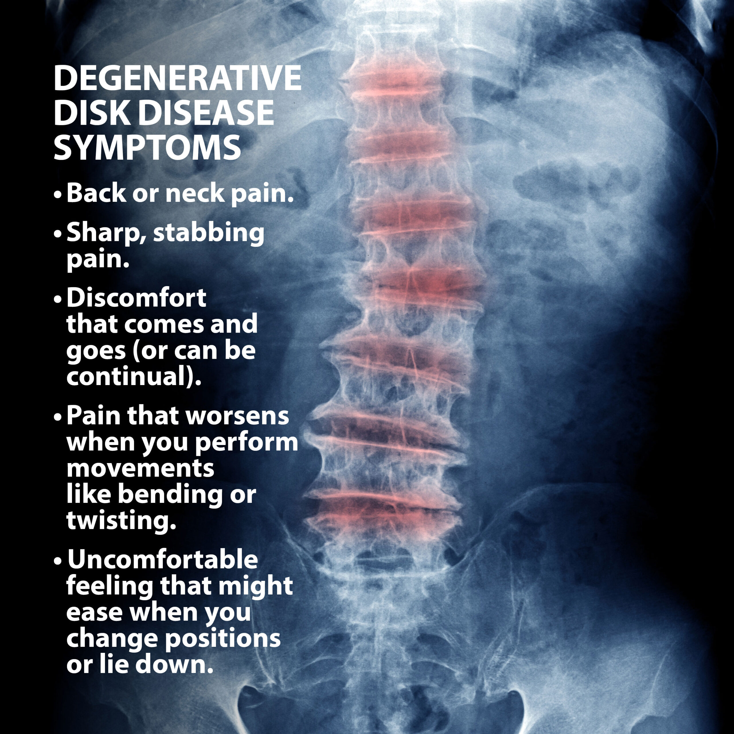Degenerative Disc Disease Physiotherapy Symptoms
